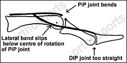 PIP Joint